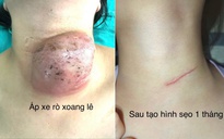 Phẫu thuật nội soi đóng rò xoang lê cho hàng chục trẻ em