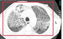 Nam lao động từ Thái Lan về nước nguy kịch vì Whitmore