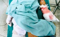 Chế tạo pháo, học sinh lớp 6 bị pháo nổ nát bàn tay