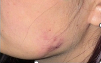 Tai biến phức tạp sau tiêm thon gọn hàm tại spa