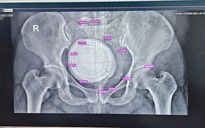 Lấy viên sỏi bàng quang "như quả bóng" khỏi nữ bệnh nhân 36 tuổi