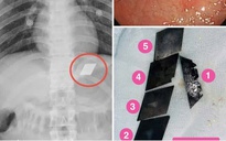 Hãi hùng một bệnh nhân "ngáo đá" ở TP HCM nuốt trọn bộ dao 5 món vào bụng
