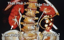 Người phụ nữ được phát hiện có 4 quả thận khi khám đau lưng