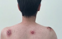 Vết loét tự lành – Dấu hiệu ban đầu của căn bệnh tình dục chết người