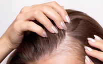 Chế độ ăn uống của 61.000 người hé lộ nguyên nhân gây rụng tóc