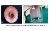 Qua 3 bệnh viện mới phát hiện dị vật - hạt mãng cầu bít phổi bé trai