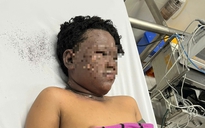 Bé trai với gương mặt cháy đen tự chạy về nhà để người thân đưa đi bệnh viện