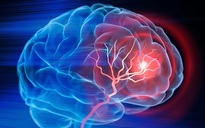 Mỹ phát triển phương pháp trị đột quỵ mới, chỉ cần 1 lần truyền dịch