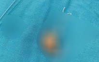 Người phụ nữ phát hiện sự thật sau 22 năm đặt vòng tránh thai