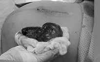 Thai 34 tuần, phát hiện u buồng trứng chèn ép