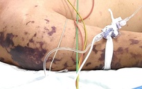 Não mô cầu gây nguy kịch, dễ nhầm với liên cầu khuẩn lợn