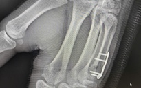 Nam sinh gãy xương bàn tay sau cú đấm boxing