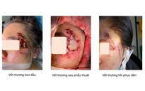 Ghép da thành công cho cô gái bị hoại tử vùng mặt sau tai nạn giao thông