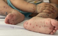 Tay chân miệng tăng mạnh, trẻ em chiếm hơn 99% ca mắc