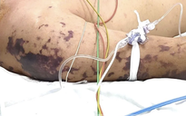 4 ca tử vong do não mô cầu, Bộ Y tế cảnh báo nguy cơ