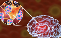 Bệnh nhi 2 tuổi bị viêm não mô cầu đã không qua khỏi