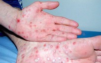 Thông tin nổi bật tại TPHCM ngày 4-5: Người mắc bệnh giang mai tăng; mở rộng đường Trần Bình Trọng