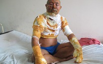 Ăn lẩu, thực khách bị cồn đốt cháy mặt