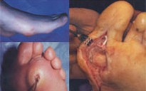 Đo đường huyết để kiểm soát tốt bệnh đái tháo đường