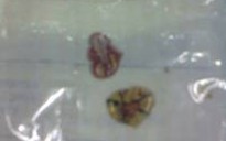 Chị 3 tuổi “cho” ăn, bé 1 tháng rưỡi dị vật đường thở