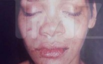 Ảnh Rihanna bị người yêu hành hung