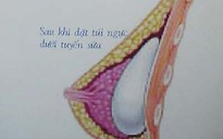 Nâng ngực có làm mất khả năng tiết sữa?