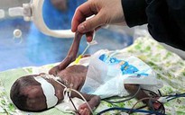 Bé sơ sinh có hộp sọ bằng quả trứng vịt
