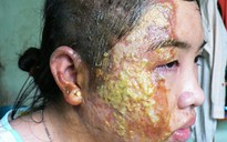 Thiếu nữ bị dội nước sôi bãi nại cho cha dượng