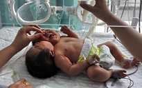 Bé gái sơ sinh 2 đầu ở Trung Quốc