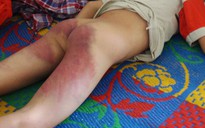 Vụ bé 11 tuổi bị đánh: chỉ mấy cái sau mông (!?)