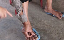 Sờ lông sâu róm, nhiều người mắc bệnh lạ