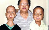 Hội chứng già trước tuổi