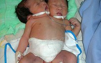 “Bé gái hai đầu” là hai cơ thể dính nhau