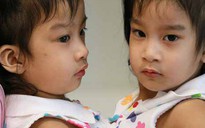 Tách rời cặp song sinh dính nhau