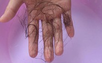 Nên lo sớm khi tóc chưa rụng