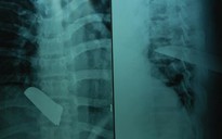 Nam thanh niên bị đâm thủng tim, phổi