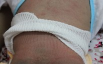 Trẻ sơ sinh bị bỏng sau khi được nữ hộ sinh tắm?