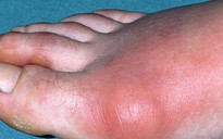 Triển vọng trị bệnh gout