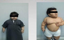 Bé trai 2 tuổi phẫu thuật cắt dạ dày để giảm cân