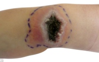 Nhiễm virus đậu mùa sau khi giải cứu mèo