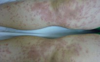 Suýt chết vì dùng thuốc nam trị nóng trong người