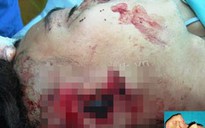 Nối liền tai bị xẻo đứt rời