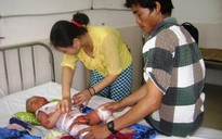 Bé trai bỏng toàn thân do dị ứng thuốc