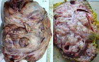 Bé 4 tháng tuổi mang khối u quái khổng lồ