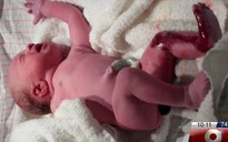 Bé gái 9 tháng tuổi không có da chân