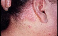 Bệnh nhân vảy nến dễ bị bệnh tim mạch