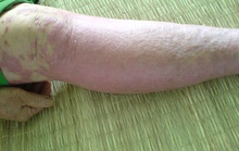 Vòng luẩn quẩn của vảy nến