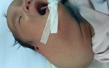 Mổ bắt bé gái vì khối bướu kẹt ở vùng kín người mẹ