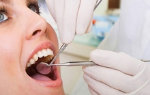Thắc mắc về việc cạo vôi răng khi viêm nướu