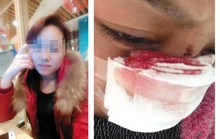 Trung Quốc: Cô gái bị chồng cắt mũi